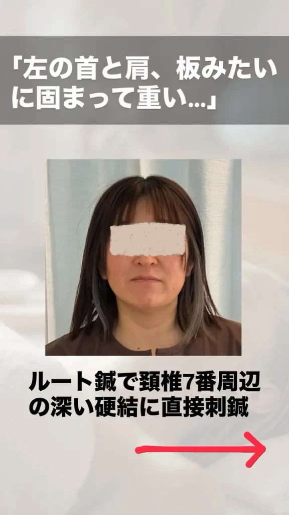 ルート鍼治療 眼精疲労のビフォーアフター 施術前