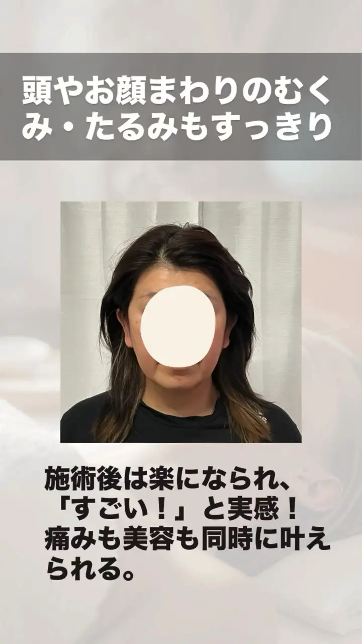 鬼美容鍼 不調改善のビフォーアフター 施術後