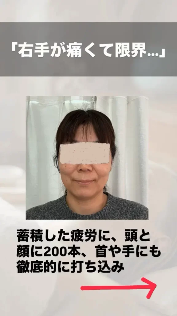 鬼美容鍼 不調改善のビフォーアフター 施術前