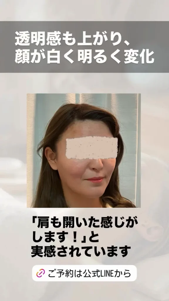 鬼美容鍼 くすみ・不調改善のビフォーアフター 施術後