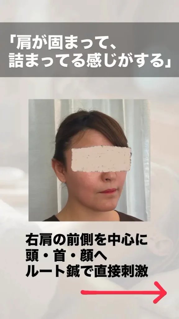 鬼美容鍼 くすみ・不調改善のビフォーアフター 施術後