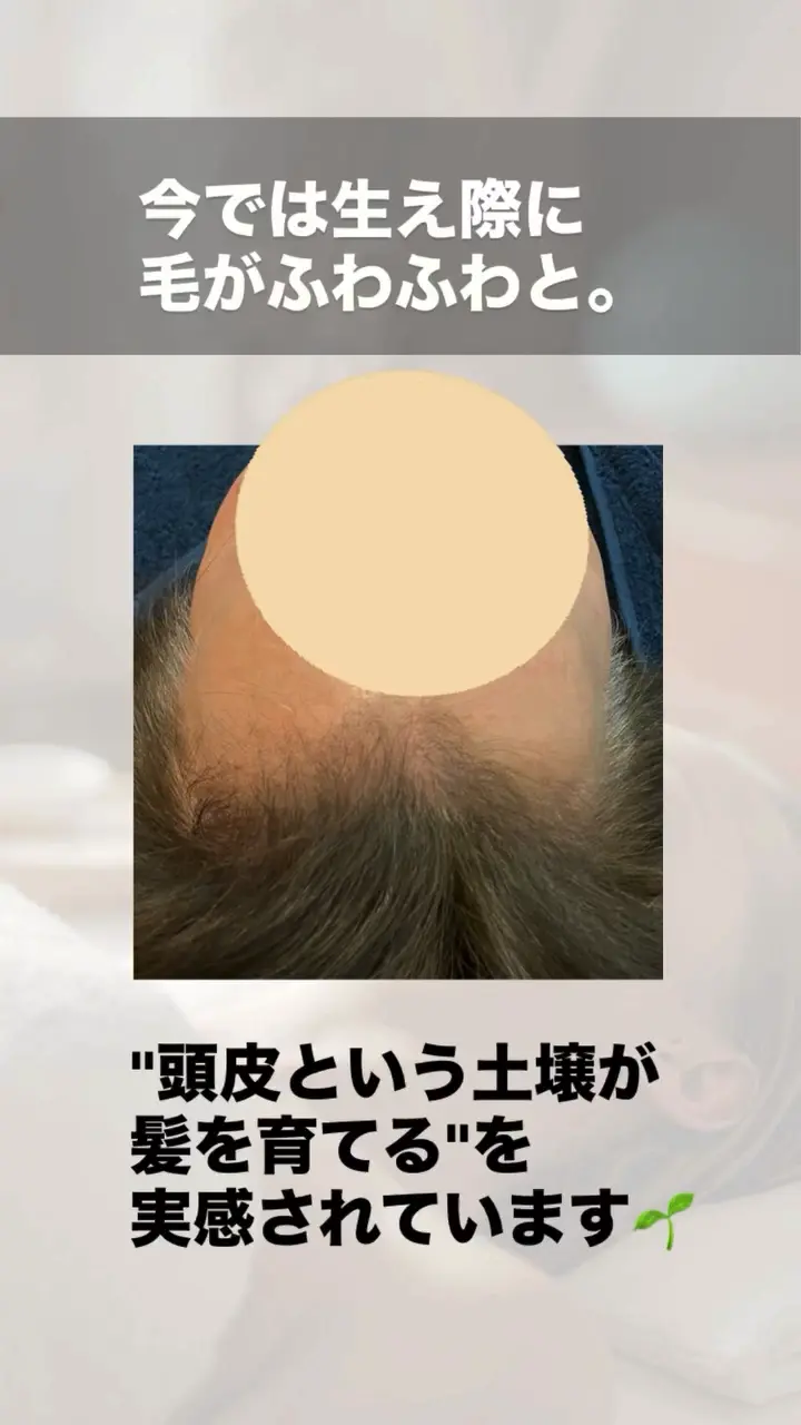 ルート鍼治療 育毛・薄毛改善のビフォーアフター 施術後