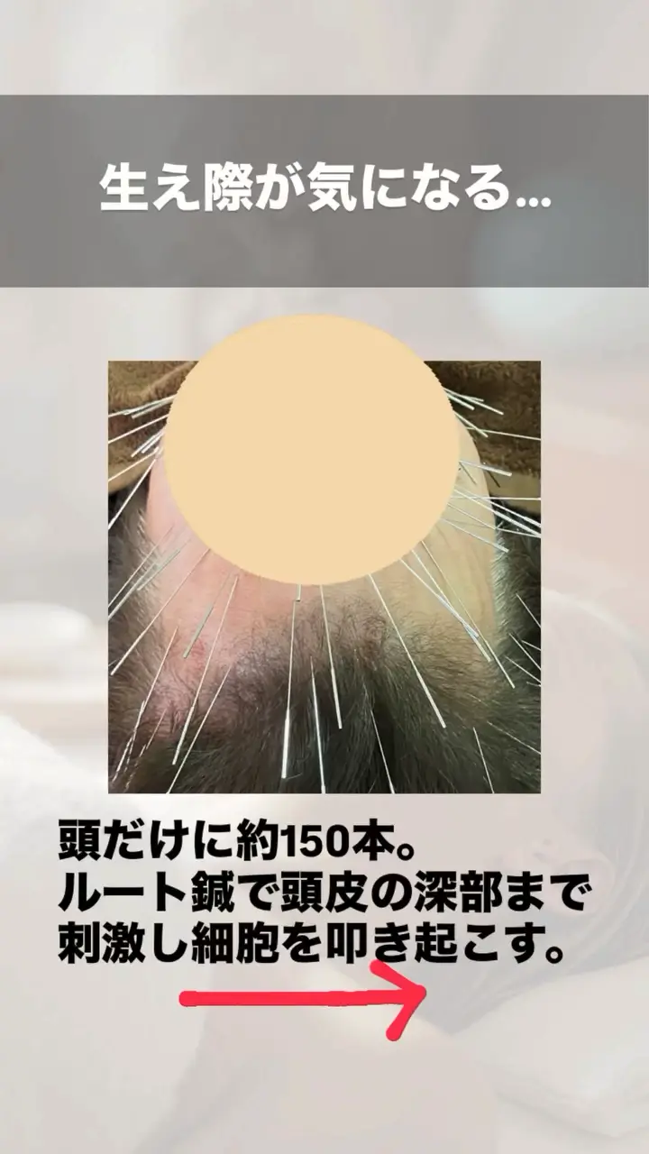 ルート鍼治療 育毛・薄毛改善のビフォーアフター 施術前