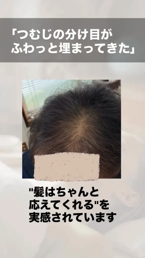 ルート鍼治療 育毛・薄毛改善のビフォーアフター 施術後
