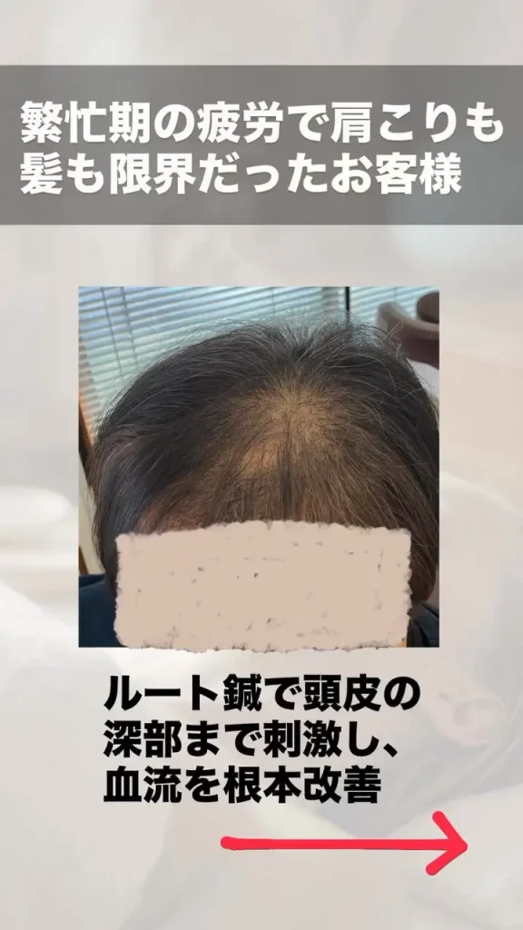 ルート鍼治療 育毛・薄毛改善のビフォーアフター 施術前